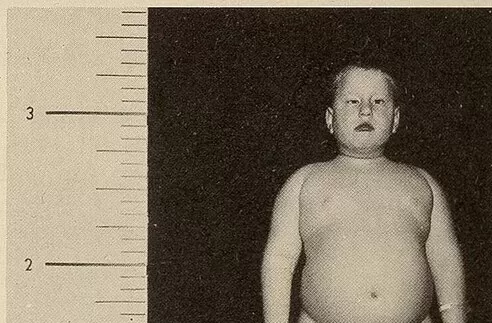 The Ongoing Struggle for Prader-Willi Syndrome Support by Documen Support Services News and Blogs