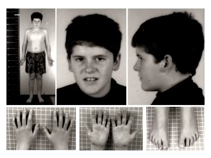 Game-Changing Progress in Prader-Willi Syndrome Signals New Treatment Future